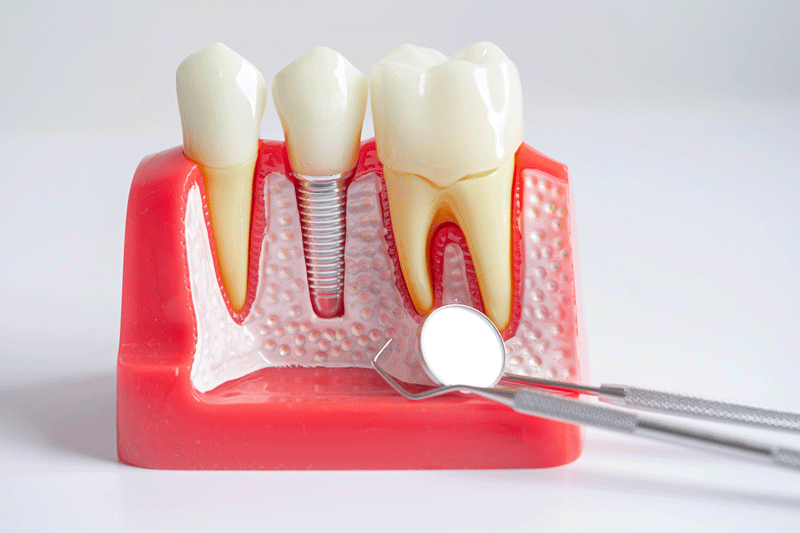 Unraveling the Magic of Dental Teeth Replacement: Embracing Dental Implants